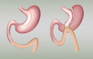 dr gulden balli mini gastric by pass 1